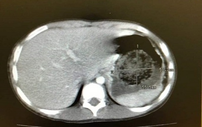 Tin tức đời sống ngày 3/6: Phẫu thuật lấy khối tóc gần 1kg trong bụng bé 11 tuổi