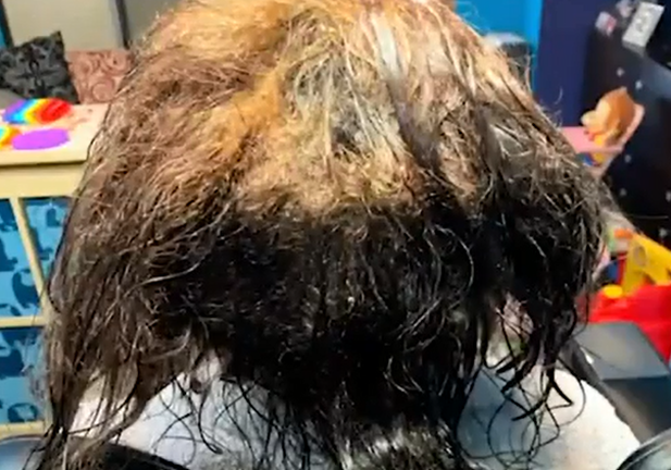 Chuyên gia phòng khám hết hồn vì mái tóc bết đầy chấy của cô gái, ra tay xử lý khiến ai nấy trầm trồ