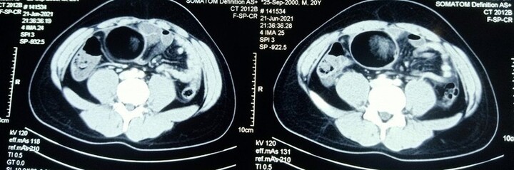 Tin tức đời sống ngày 28/6: Phẫu thuật cắt bỏ khối u tinh hoàn cho nam thanh niên 20 tuổi