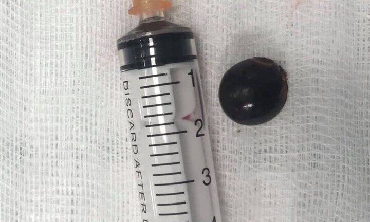 Tin tức đời sống ngày 17/7: Gắp thành công hạt nhãn trong phổi bé gái 12 tuổi