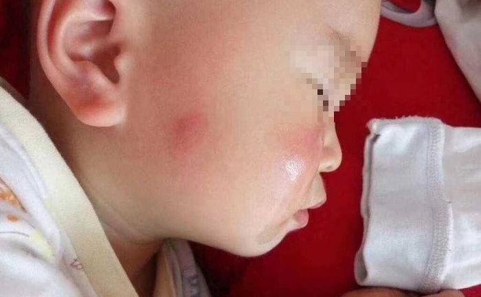 Bà nội chữa muỗi đốt theo cách lạ, cháu trai phải nhập viện cấp cứu gấp