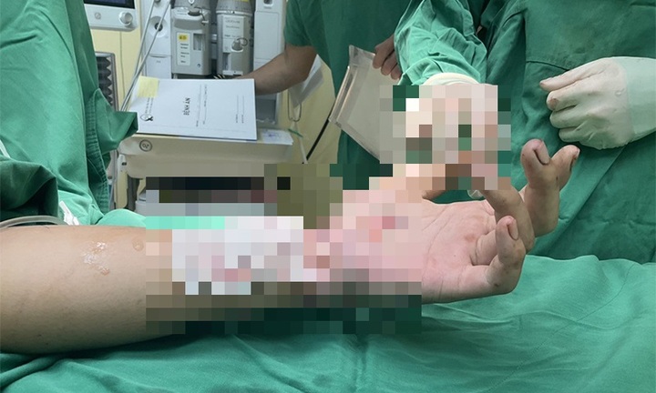 Tin tức đời sống ngày 2/10: Nối thành công bàn tay bị đứt lìa cho nam thanh niên