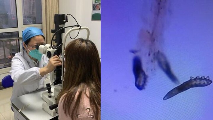 Mắt ngứa, sưng đỏ nghiêm trọng, cô gái đi khám thì giật mình trước kết luận của bác sĩ