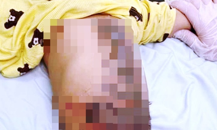 Tin tức đời sống ngày 7/11: Bệnh nhi 8 tháng tuổi bị nhiễm trùng do được đắp lông chó chữa bỏng