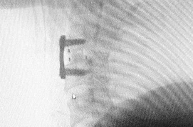 Tin tức đời sống ngày 20/11: Cứu kịp thời bệnh nhân 46 tuổi thoát nguy cơ bại liệt tứ chi