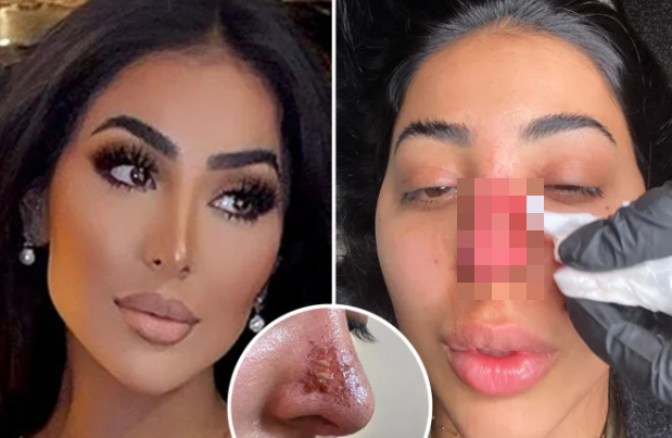 Nàng mẫu xinh đẹp suýt mất mũi vì tiêm filler, hình ảnh cận cảnh khiến ai nấy bủn rủn tay chân