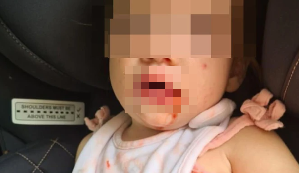 Con gái mọc mụn rộp ở miệng không thể ăn uống, mẹ lập tức cảnh báo một hành động nguy hiểm