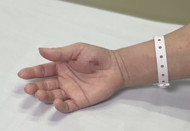 Tin tức đời sống ngày 3/12: Người phụ nữ nhập viện cấp cứu vì vết cắn nhỏ của con Cu li