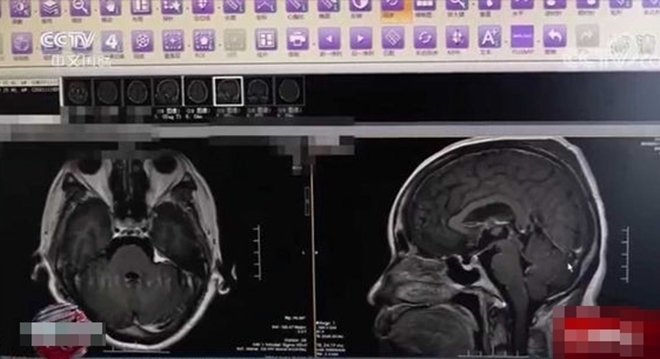 Người phụ nữ nguy kịch sau khi ăn cơm rang để tủ lạnh, bác sĩ khuyến cáo điều quan trọng