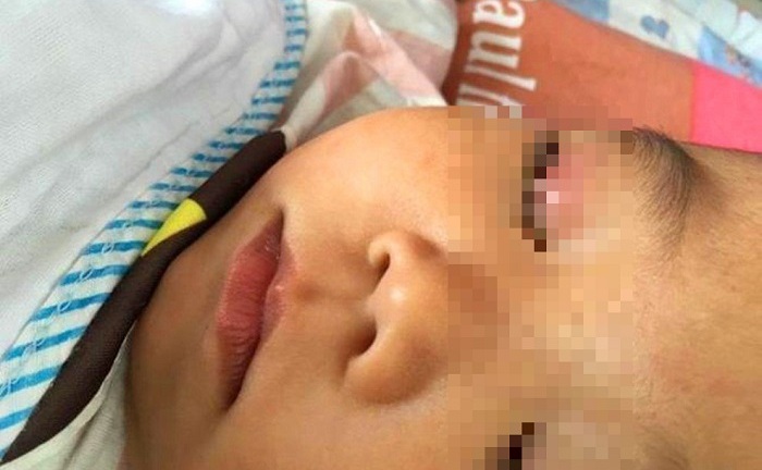 Con trai 4 tuổi nhỏ keo 502 vào mắt, cách sơ cứu của bố được bác sĩ tấm tắc khen ngợi