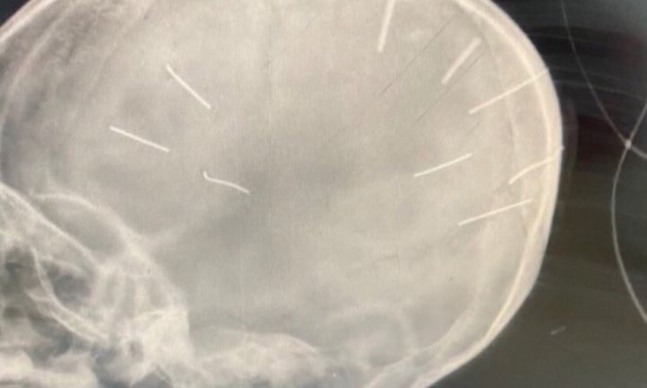 Vụ bé gái 3 tuổi có đinh trong hộp sọ: Gia đình bên nội bàng hoàng, mong sớm điều tra 