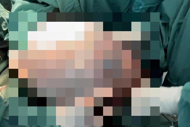 Tin tức đời sống ngày 25/2: Phẫu thuật bóc khối u nặng gần 20kg cho người phụ nữ