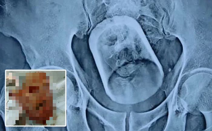 Người đàn ông đến viện vì đau bụng dữ dội, bác sĩ không dám tin khi nhìn ảnh chụp X-quang