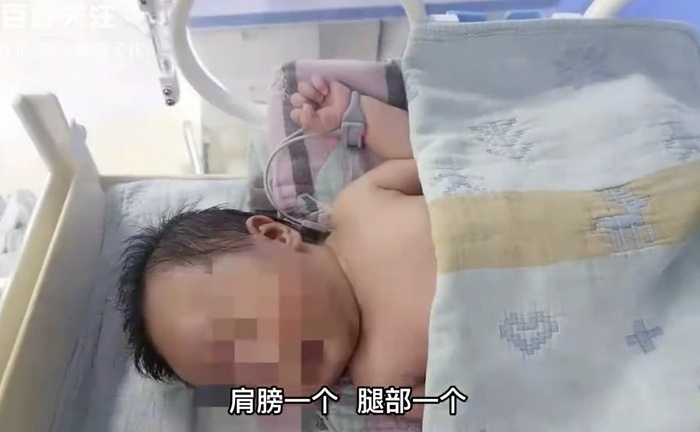 Bé trai bỗng có vết thương ở đùi, kết quả chụp CT hé lộ hành vi nhẫn tâm của bảo mẫu