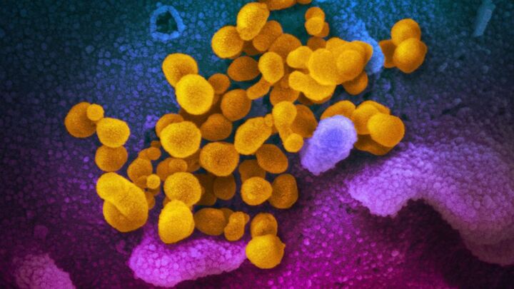 Bệnh nhân mắc COVID-19 trong 505 ngày