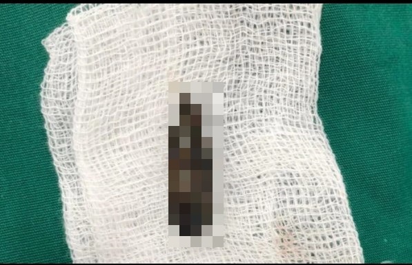 Tin tức đời sống ngày 25/4: Phẫu thuật lấy đầu đạn nằm 54 năm trong người bệnh nhân