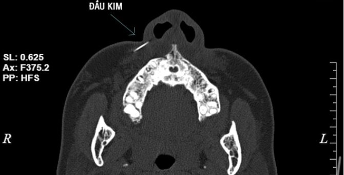 Tin tức đời sống ngày 26/4: Kim tiêm gãy, mắc trong má người phụ nữ khi tiêm filler ở salon tóc