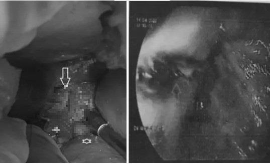 Cấp cứu người đàn ông vỡ thực quản sau bữa nhậu tại nhà