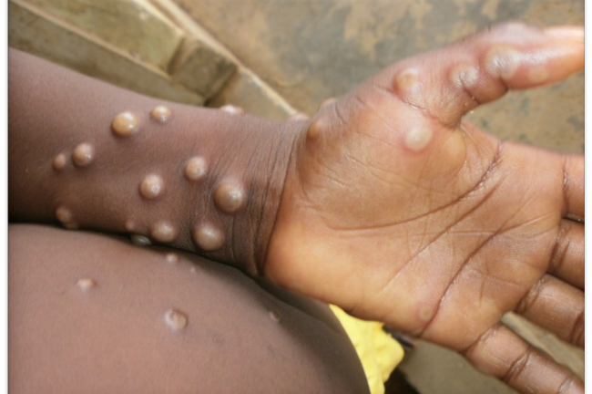 Anh ghi nhận ca bệnh đậu mùa khỉ hiếm gặp