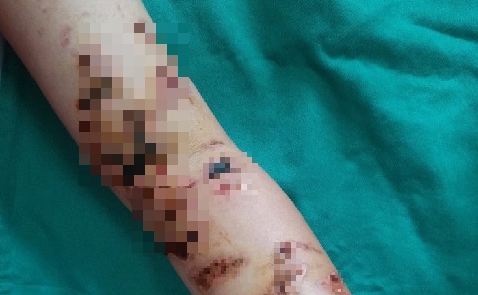 Tin tức đời sống ngày 12/5: Cơ thể bé trai 10 tuổi đầy vết thương vì bị sứa đốt