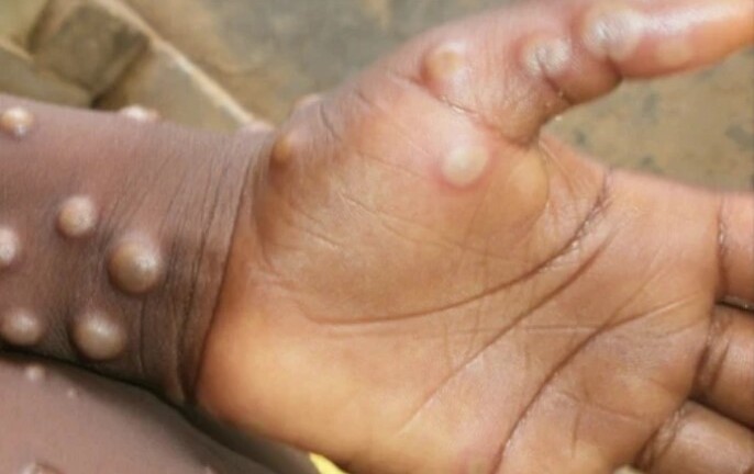 Quốc gia đầu tiên yêu cầu cách ly người mắc bệnh đậu mùa khỉ