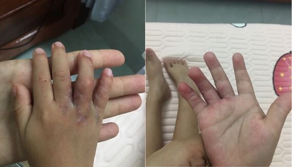 Tin tức đời sống ngày 25/5: Tách thành công 2 bàn tay dính ngón cho bệnh nhi 19 tháng tuổi