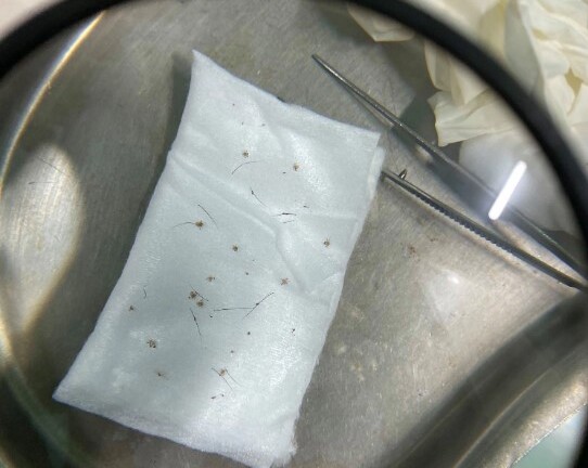 Hãi hùng chuyện gần 100 con rận mu làm tổ trên mi mắt người đàn ông