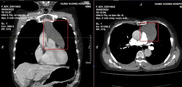 Đi khám mắt, người phụ nữ bất ngờ phát hiện u nang màng ngoài tim cực hiếm