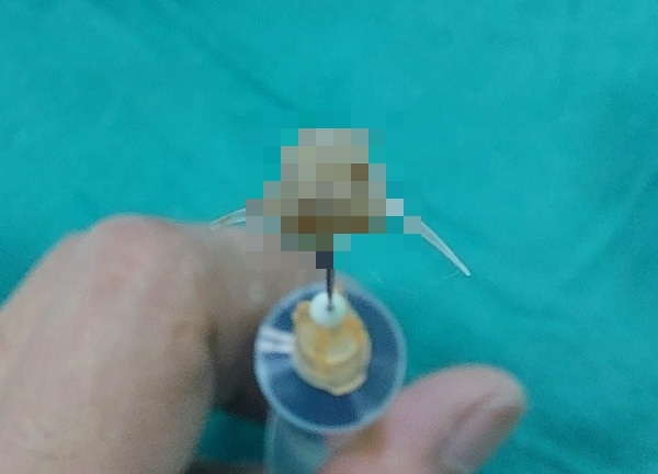 Mảnh xương cá sắc nhọn mắc trong đường thở của bệnh nhi 2 tuổi