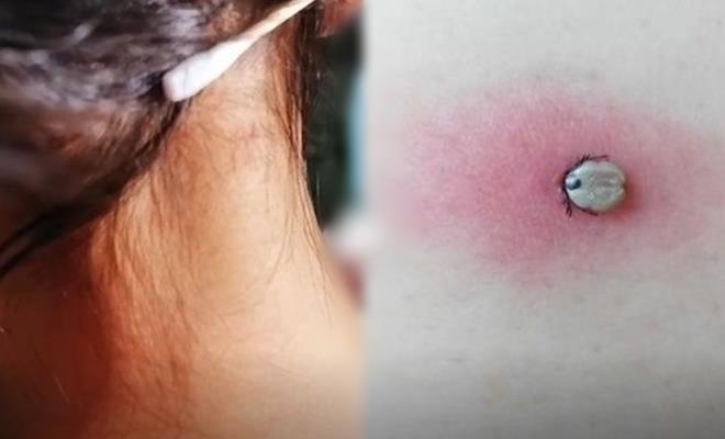 Mẹ giật mình khi phát hiện sự thật về “nốt ruồi” ở gần gáy con gái