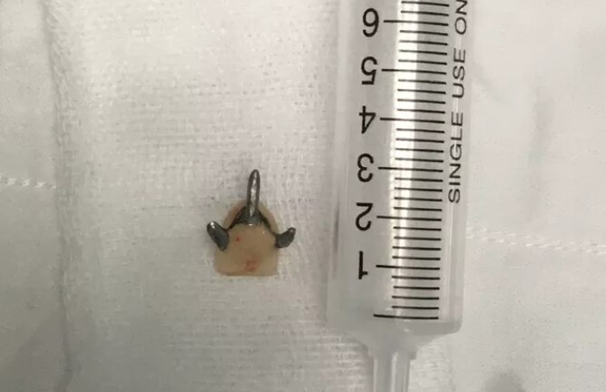 Tin tức đời sống ngày 16/6: Cô gái 29 tuổi nuốt phải răng giả trong lúc súc miệng