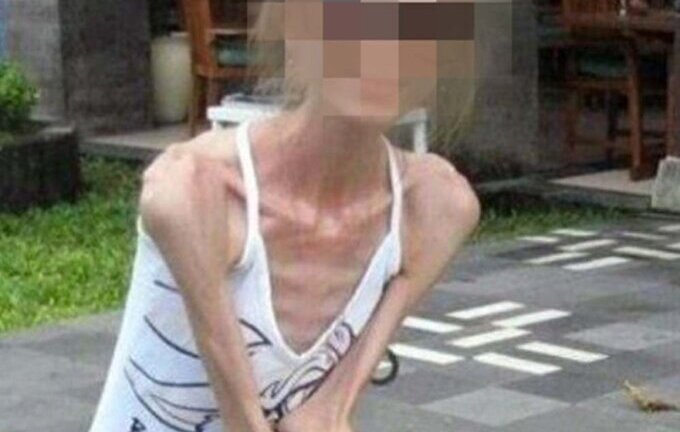 Người phụ nữ 30 tuổi chỉ nặng 25kg, ai nấy giật mình khi biết nguyên nhân