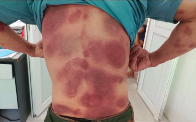 Tin tức đời sống ngày 24/6: Nhiễm độc toàn thân vì tự dùng thuốc điều trị viêm gan B