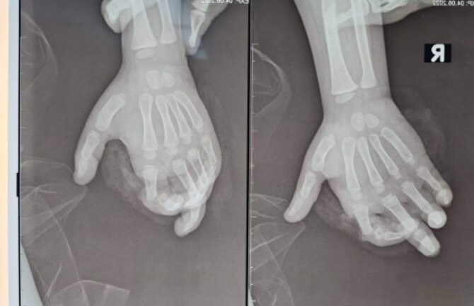 Vô tình cho tay vào máy xay sinh tố, bé gái 4 tuổi bị đứt gần rời ngón tay