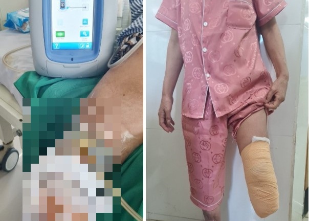 Người phụ nữ 40 tuổi phải cắt cụt 1/3 chân trái vì biến chứng của căn bệnh quen thuộc