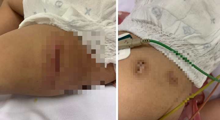 Sức khỏe bé gái 18 tháng tuổi bị đôi vợ chồng hành hạ ở Hà Nội hiện ra sao?