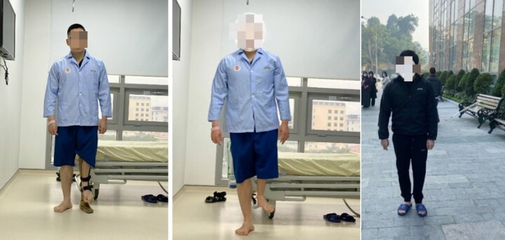 Kéo dài chân thêm 18cm cho chàng trai bị dị tật biến dạng vùng khớp háng bẩm sinh