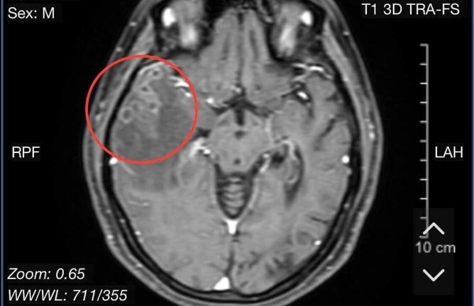 Phát hiện sán làm tổ trong não người phụ nữ 38 tuổi