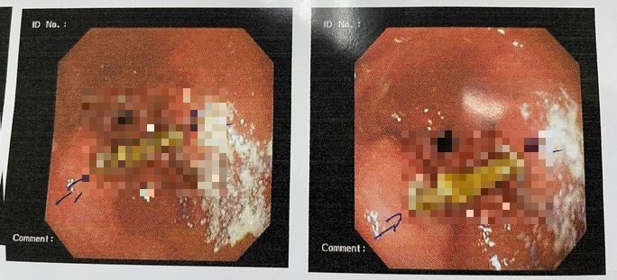 Tin tức đời sống ngày 3/9: Người đàn ông 60 tuổi bị thủng bao tử do xác trà