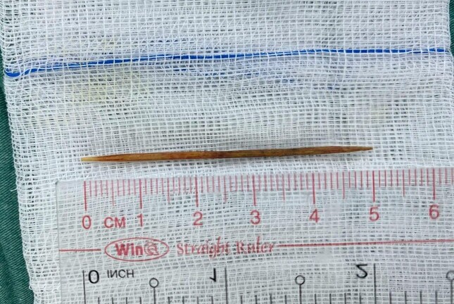 Tăm tre dài 5cm đâm thủng 2 lỗ ở tá tràng của bé trai 8 tuổi