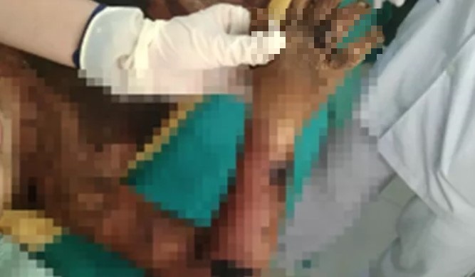 Đắp thuốc lá chữa bỏng, bé 5 tuổi nôn ra máu, bị nhiễm trùng, nhiễm độc