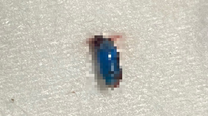 Tin tức đời sống ngày 13/9: Bé 4 tuổi nhập viện vì bị bạn học nhét đồ chơi vào tai