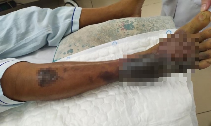 Chân hoại tử tím đen, suy gan thận do loại vi khuẩn sống ở vùng nước mặn, nước lợ