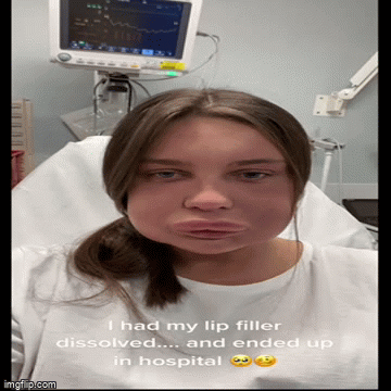 Hú hồn với thành quả làm đẹp bằng filler của cô gái 23 tuổi