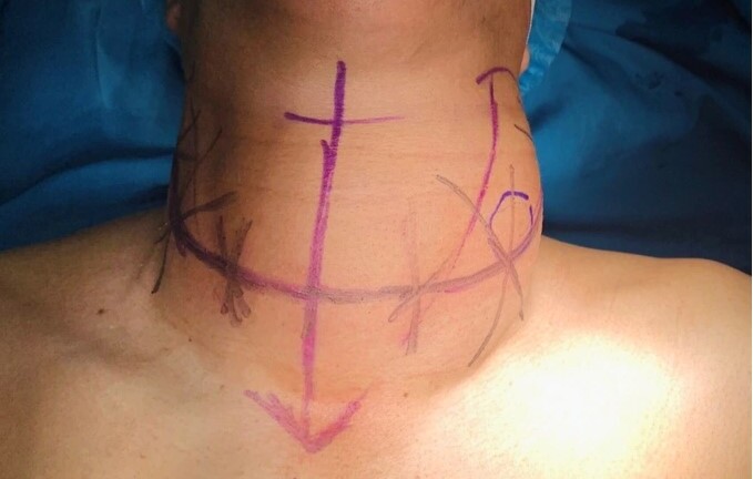 Tin tức đời sống ngày 28/9: Phẫu thuật cắt bỏ khối u tuyến giáp “khổng lồ” cho bệnh nhân 43 tuổi