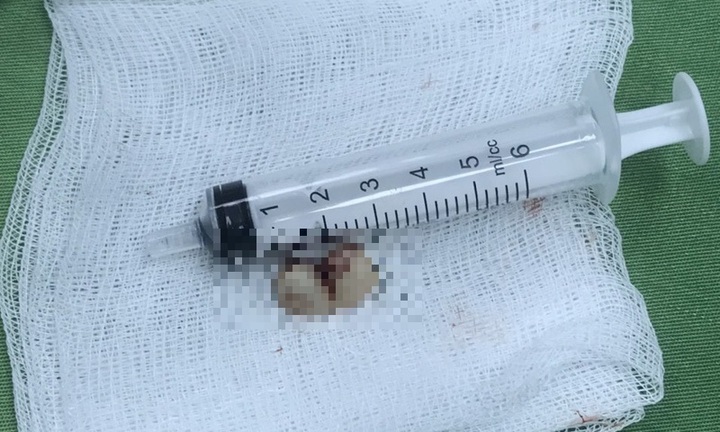 Tin tức đời sống ngày 29/9: Hai chiếc răng giả nằm trong phế quản người phụ nữ 47 tuổi