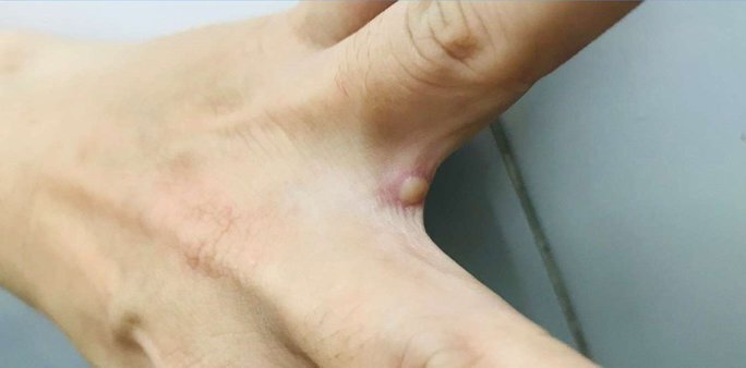 Sức khỏe của bệnh nhân mắc đậu mùa khỉ đầu tiên ở Việt Nam hiện ra sao?