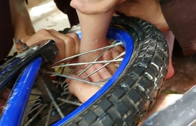 Bé 2 tuổi dập nát phần mềm gót chân vì kẹt vào nan xe đạp