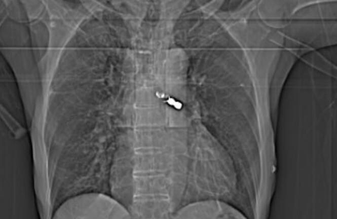 Tin tức đời sống ngày 8/10: Cụ ông 92 tuổi nhập viện cấp cứu vì nuốt phải cầu răng giả