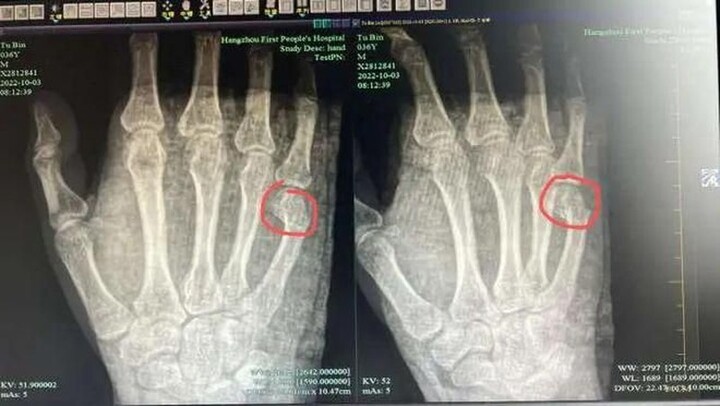 Bố bị gãy xương tay vì làm hành động này trong lúc dạy con học